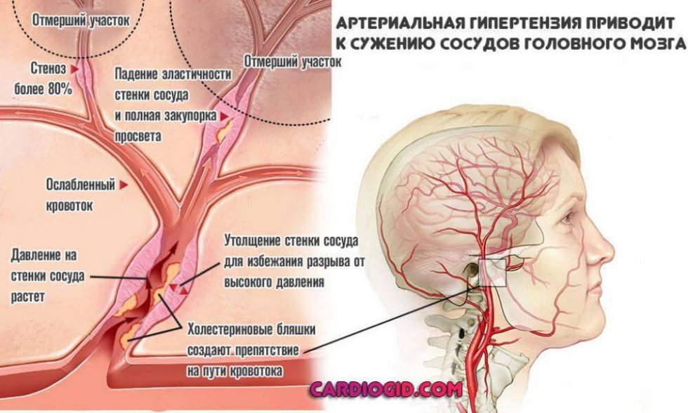 Атеросклероз, артериальная гипертензия, нейроциркулярная дистония