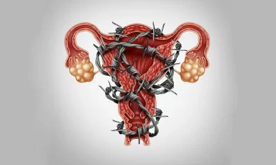 Пептиды при мастопатии, миоме матки, эндометриозе