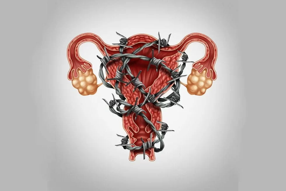 Пептиды при мастопатии, миоме матки, эндометриозе