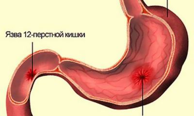 Гастрит, язвенная болезнь желудка и 12-перстной кишки