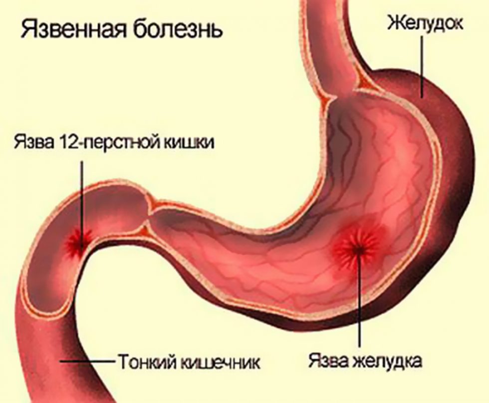Гастрит, язвенная болезнь желудка и 12-перстной кишки